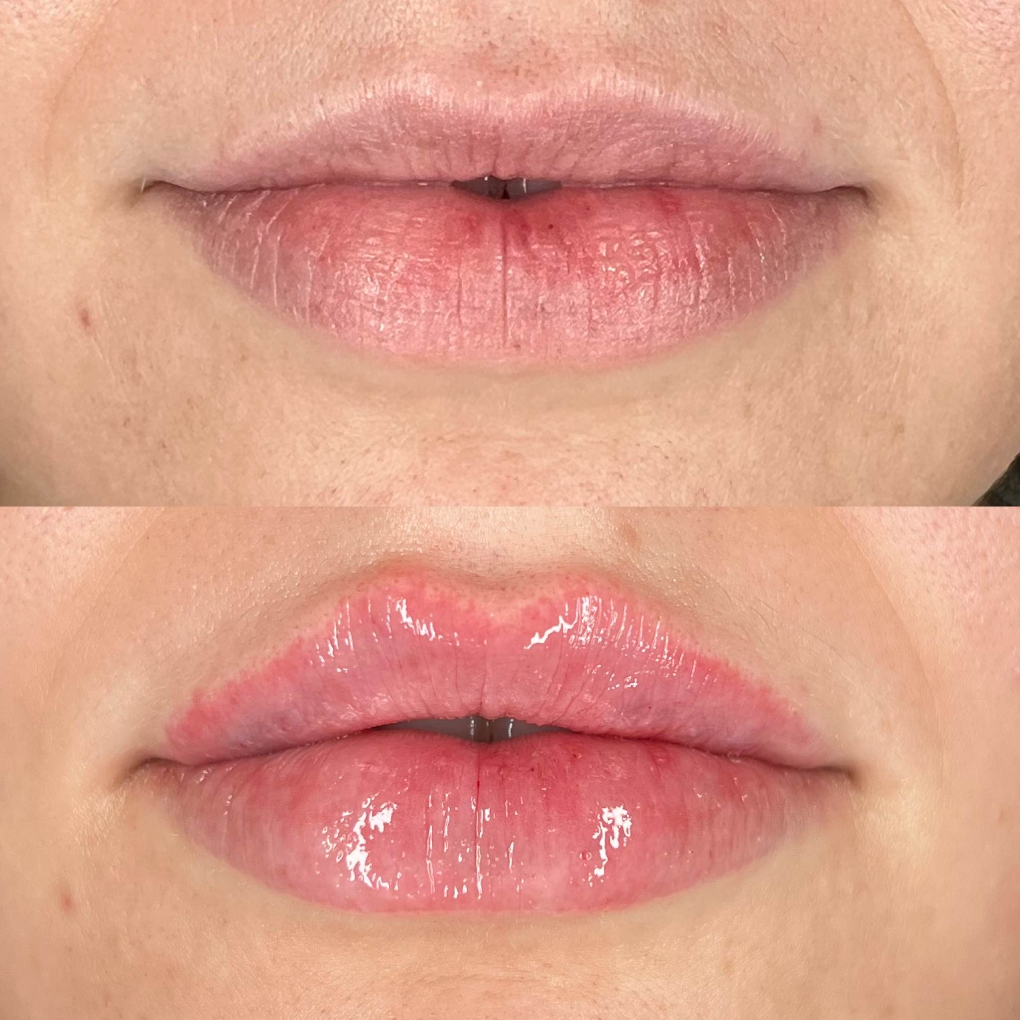Botox